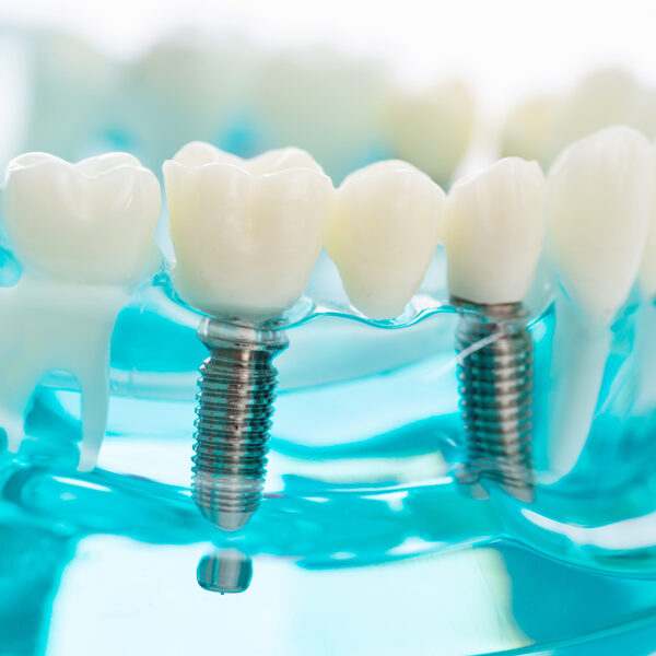 Implantat